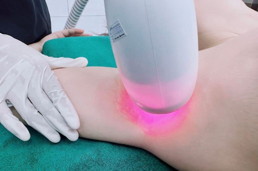 Công nghệ triệt lông Diode Laser