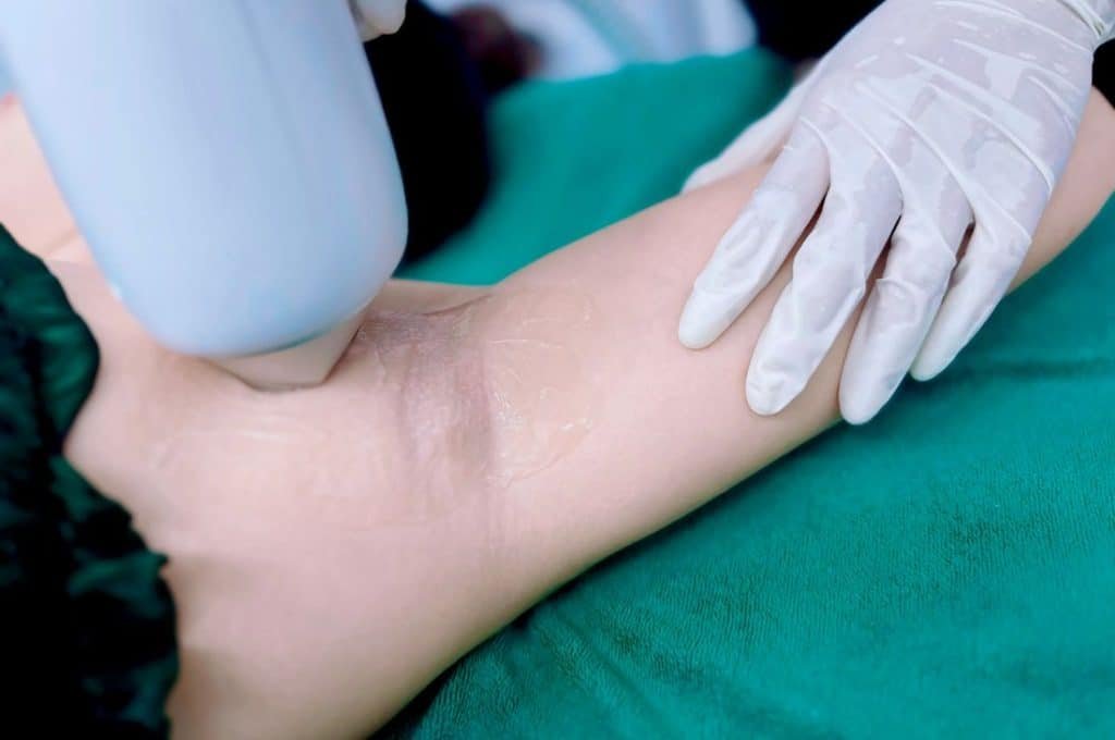 Địa điểm nào triệt lông hiệu quả và an toàn?